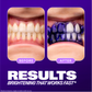 Moolinse Professional Teeth Whitening Strips