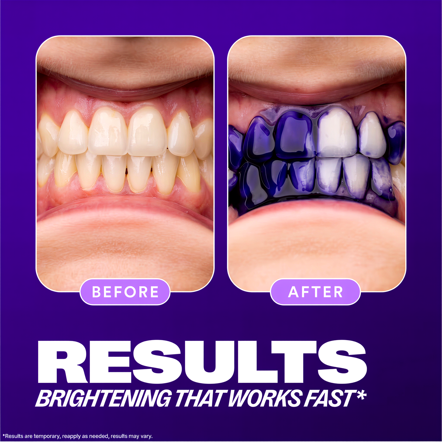 Moolinse Professional Teeth Whitening Strips